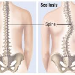 Should early Scoliosis detection be important for parents and health professionals?