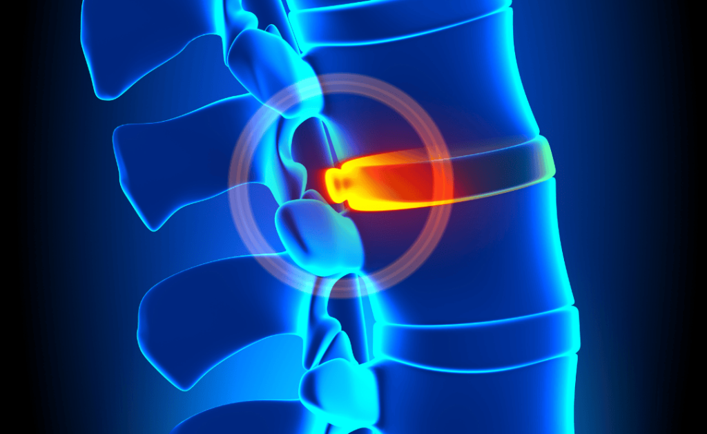 Chiro For A Bulging Disc - What is a bulging disc